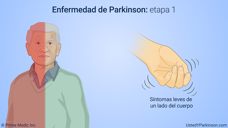 Enfermedad de Parkinson: etapa 1