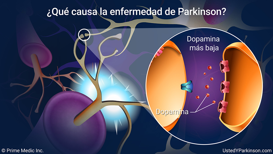 ¿Qué causa la enfermedad de Parkinson?