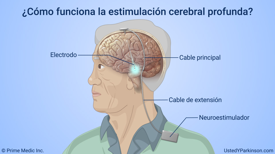 ¿Cómo funciona la estimulación cerebral profunda?