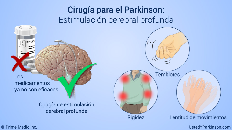 Cirugía para el Parkinson:   Estimulación cerebral profunda