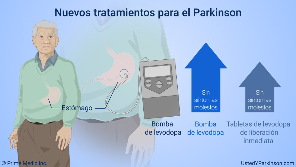 Nuevos tratamientos para el Parkinson