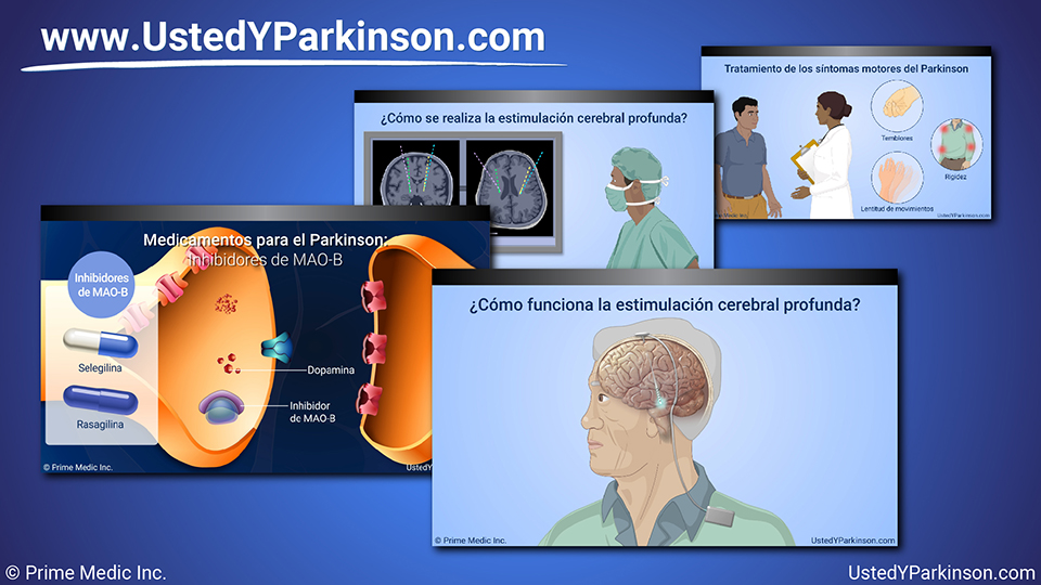 Presentación de diapositivas - Tratamiento y manejo de la enfermedad de Parkinson